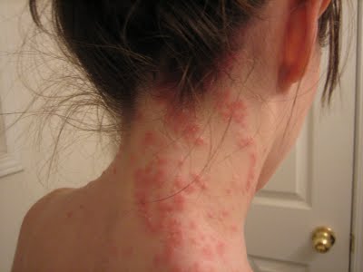 rash